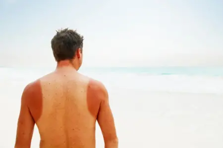 Non solo scottature: i rischi dell'esposizione al sole per la pelle di un uomo e come proteggerla con prodotti naturali